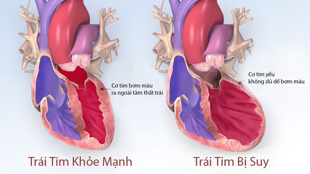 Biến chứng nặng nề và ở giai đoạn cuối là suy tim.